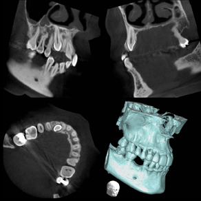 Retinierter Zahn 13  und persistierender Zahn 53